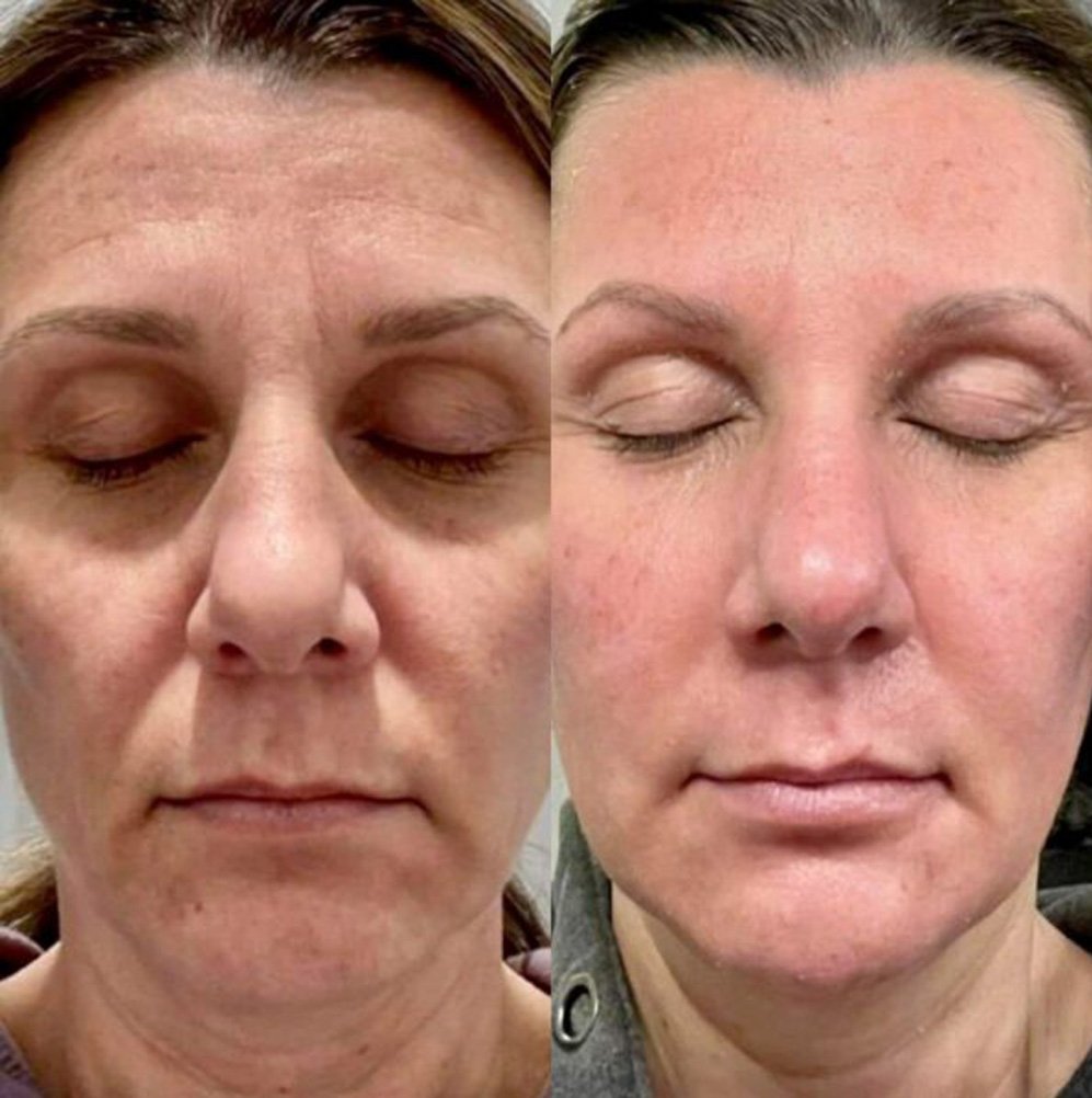 BA-FP21 Fusion Plasma Machine Treatment Before After