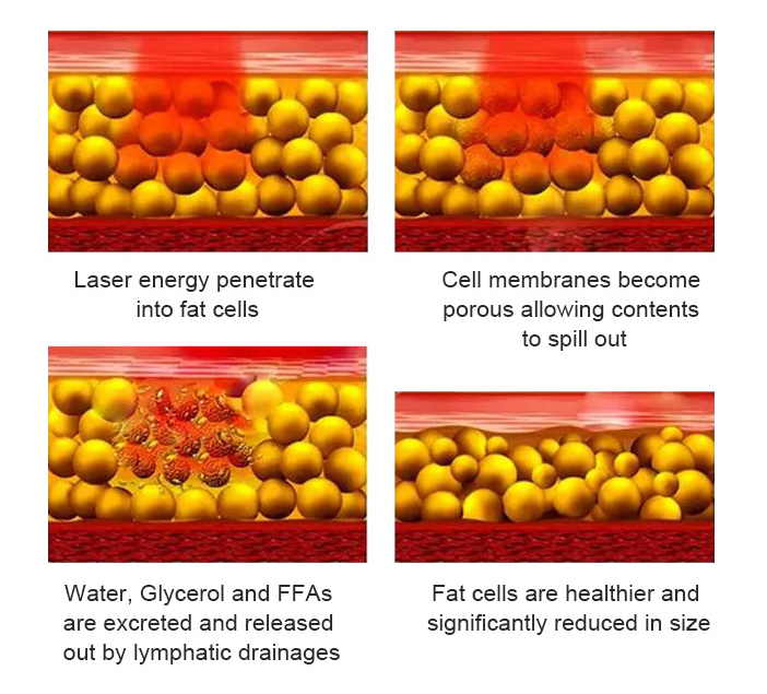 BA-EM25 lipolysis machine principle