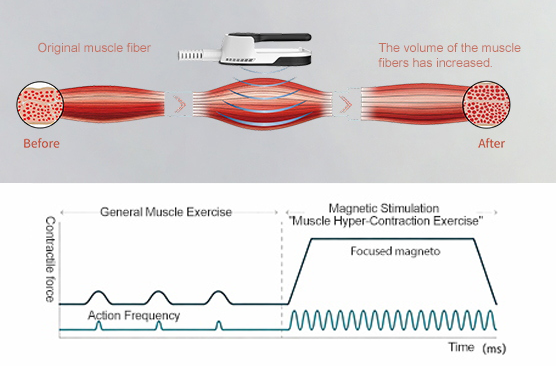 BA-ES32 2 in 1 Coolwave Magnetic Stimulation Machine hifem principle