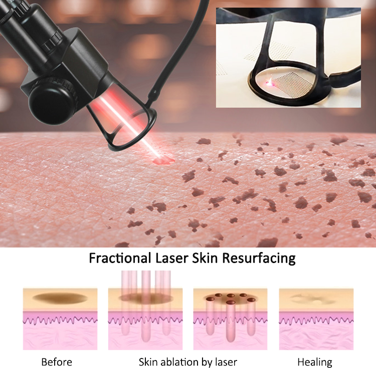BA-FC25 Fractional co2 laser beauty machine co2 principle