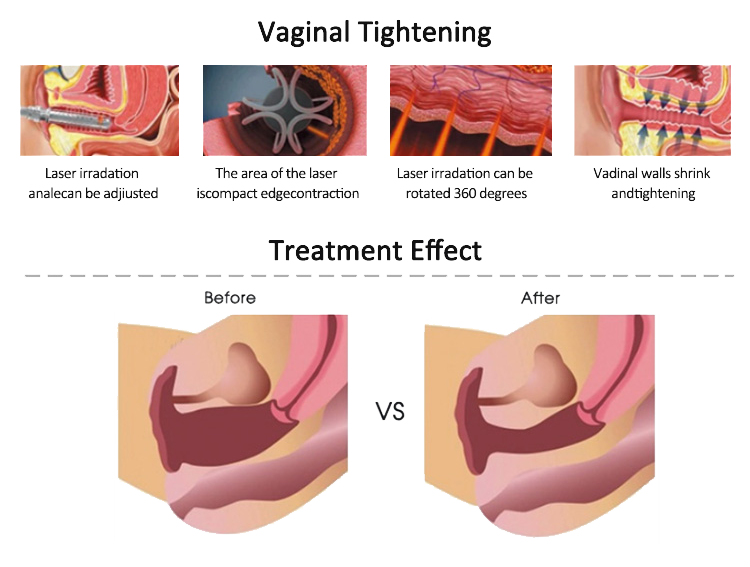 BA-FC25 Fractional co2 laser beauty machine vaginal tightening principle