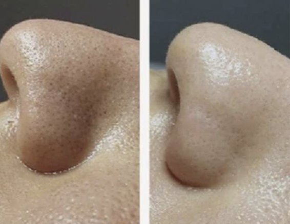 Deep skin cleaning