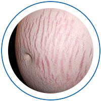 Eliminating pregnancy induced wrinkles