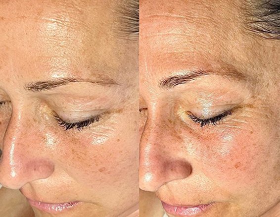 Light Wrinkles and Firmness