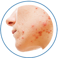 Removal of acne, acne pits and acne marks