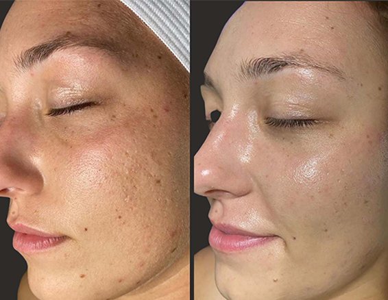 Skin rejuvenation