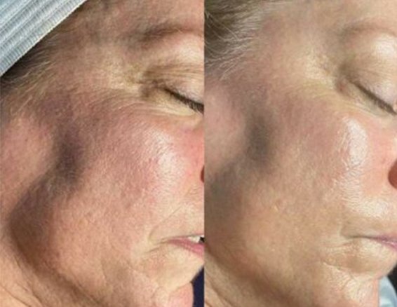 Smoothing and refining skin