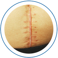 Treating old and new scars