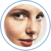 Treatment of pigmented lesions such as freckles and ostrum miracles