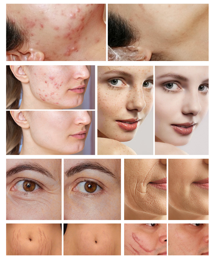 ba-fc25 before after