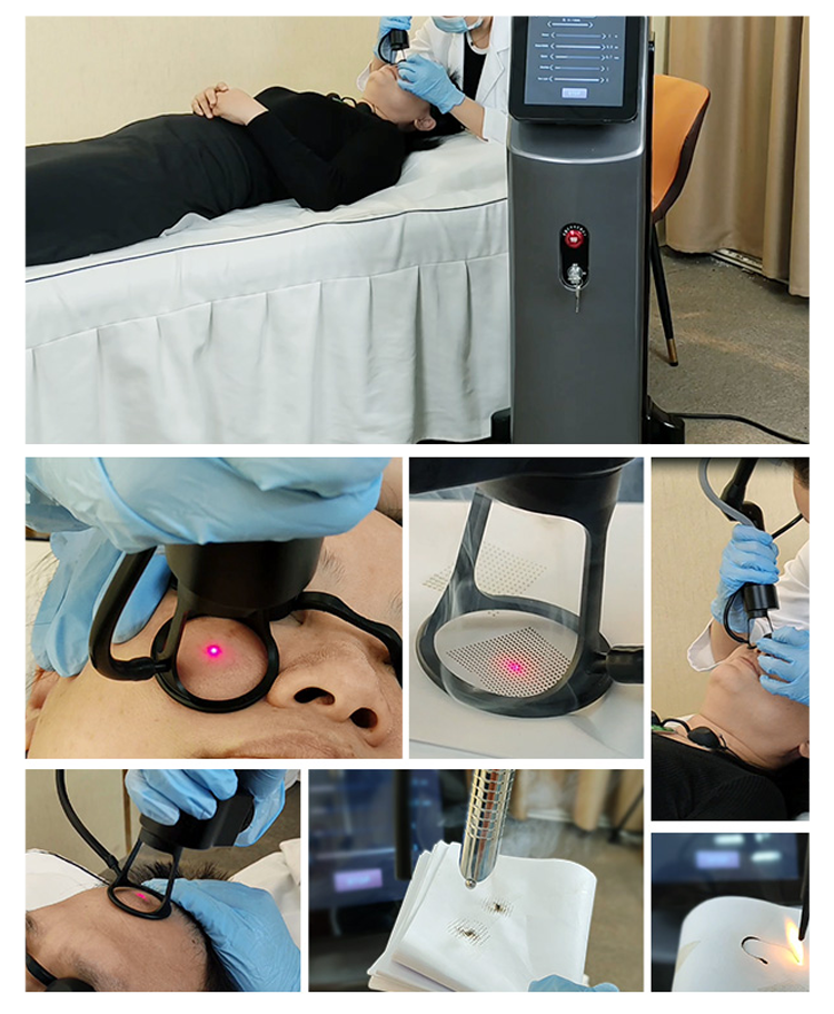 ba-fc25 treatment