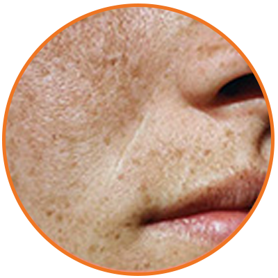 fade spots