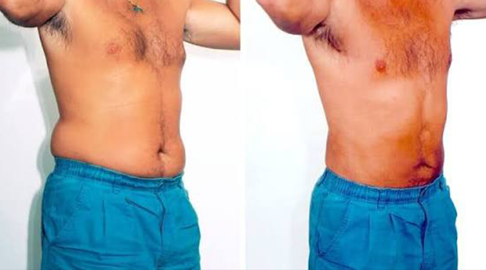 men fat dissolving before after