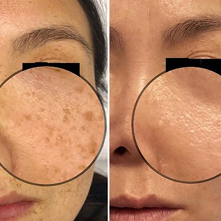 picosecond laser spots removal-1