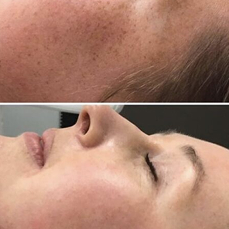 picosecond laser spots removal-2