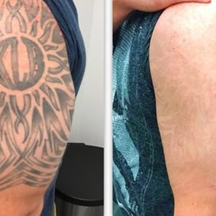 picosecond laser spots removal-3