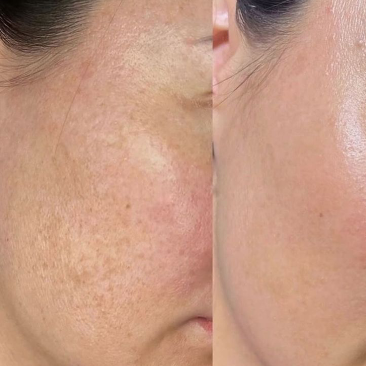 picosecond laser spots removal-4