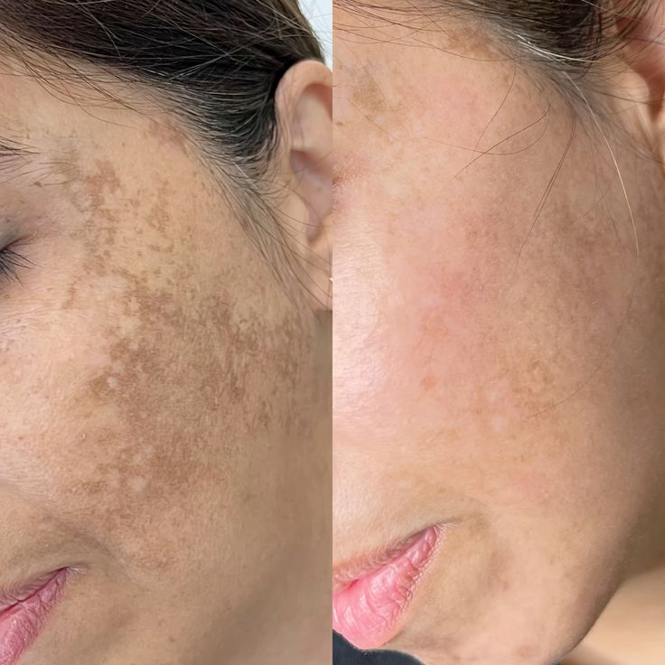 picosecond laser spots removal-5