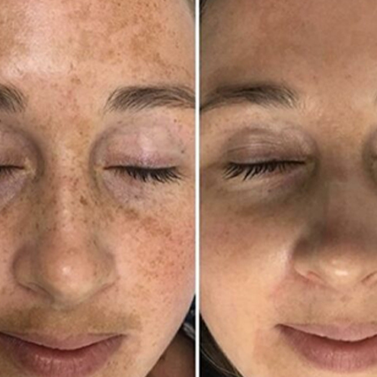 picosecond laser spots removal