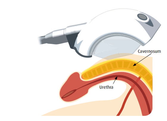 linear focused shockwave therapy machine for ed