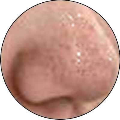 ba-an24-blackheads